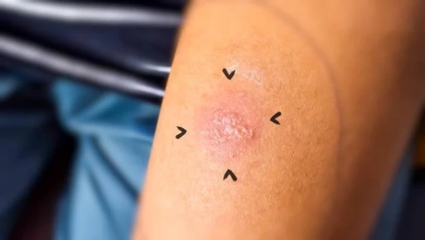 TB Skin Test in Aboud Health Clinic in Mississauga